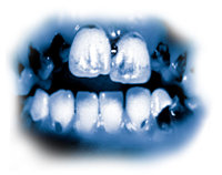De giftige ingredienser i meth kan medføre alvorlig forrådnelse af tænderne, kendt som ”meth-mund”. Tænderne bliver sorte og plettede, og de rådner ofte i en sådan grad, at de må trækkes ud. Tænderne og gummerne ødelægges indefra, og rødderne rådner væk.